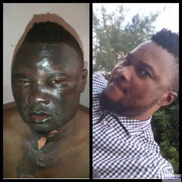 Photos: Actor Von Apochi makes amazing recovery after being burnt in a car fire last year